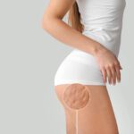 Cellulite: What Causes It and How to Get Rid of It | The Wellness Clinic