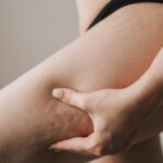 Cellulite | The Wellness Clinic at New Boston Village