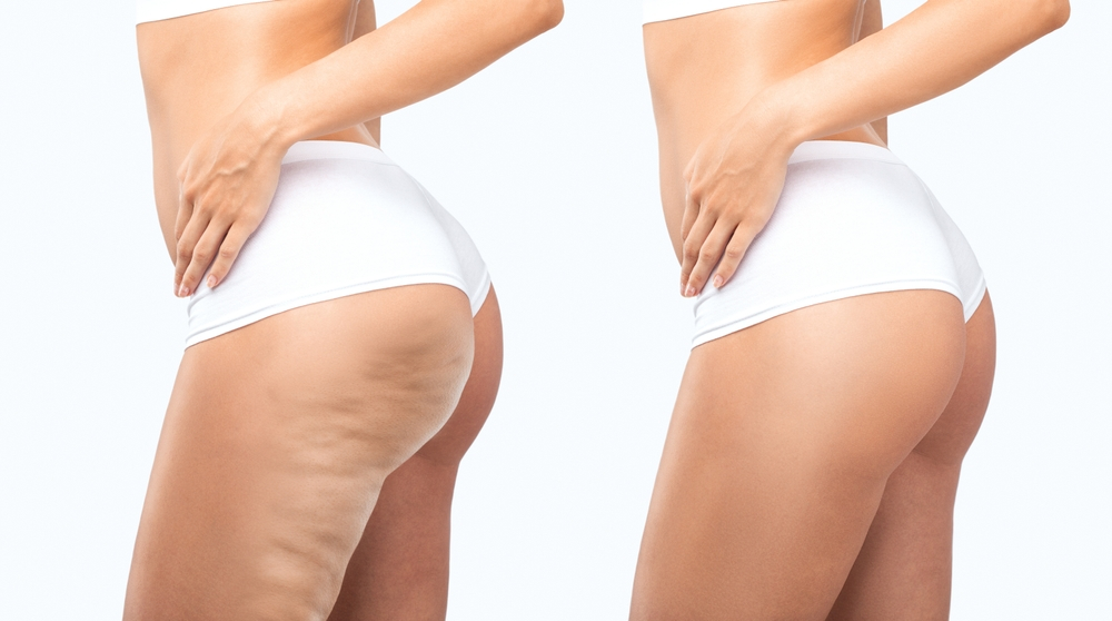 Cellulite | The Wellness Clinic at New Boston Village
